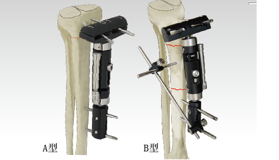 Orthofix外固定架